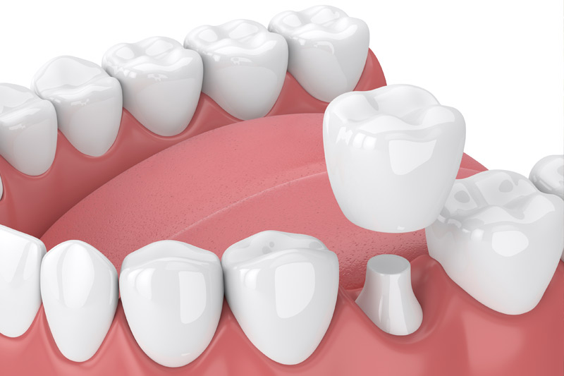 Dental Crowns in Lakeview