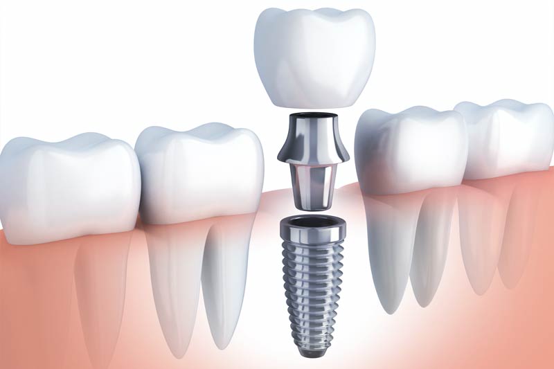 Implants Dentist in Lakeview