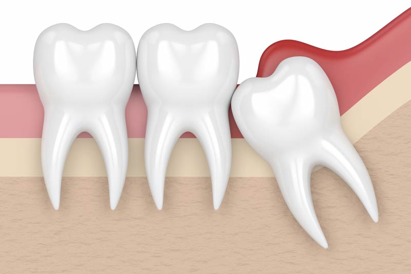 Wisdom Tooth Removal in Lakeview
